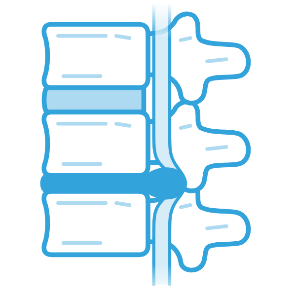 Illustration of a degenerated, bulging disc pressing on the spinal cord