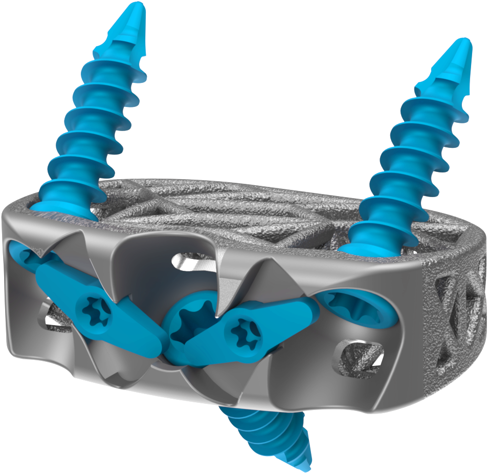 Anterior Spine Truss System™ – Stand Alone