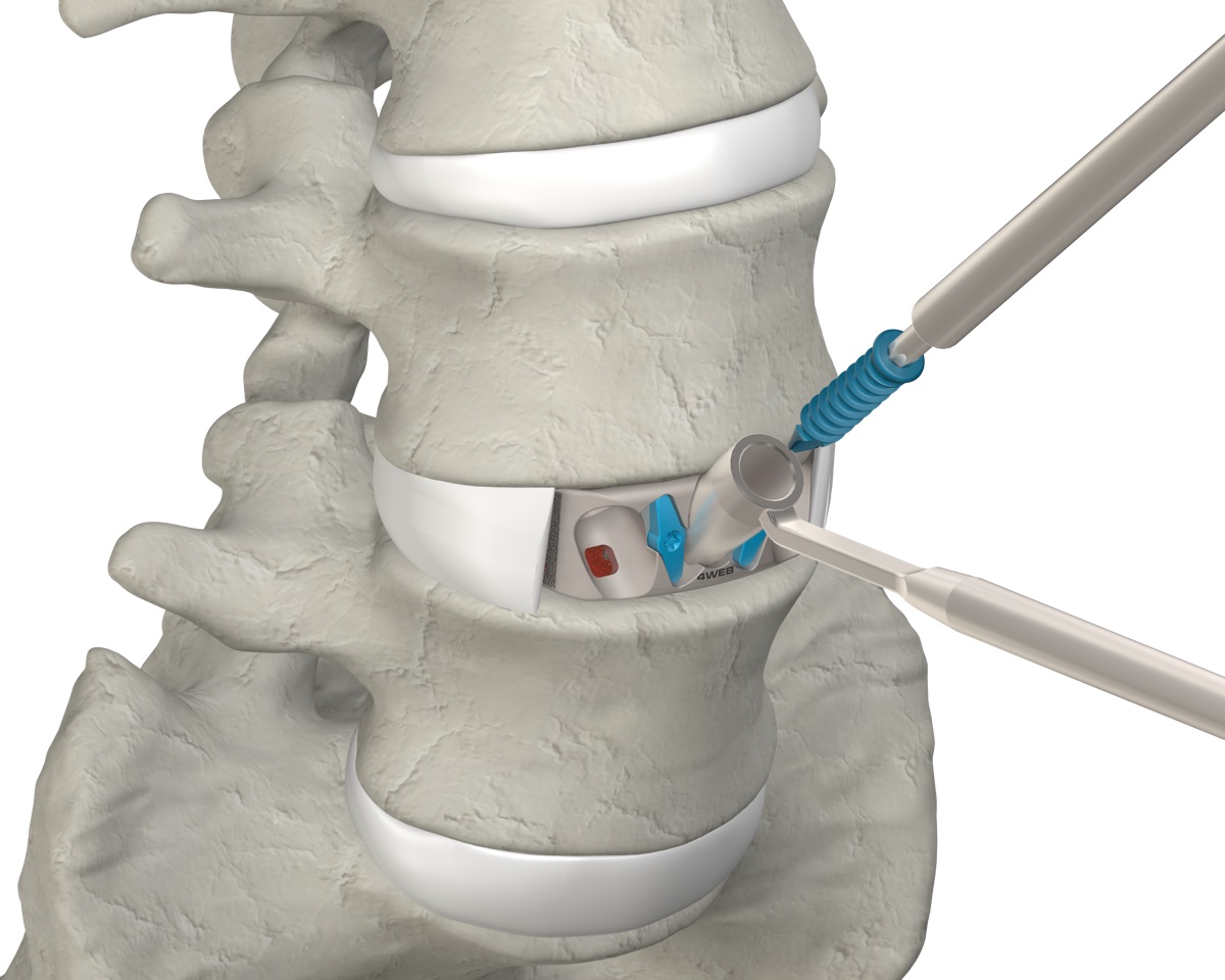 ASTS-SA inserter placing the implant into the disc space