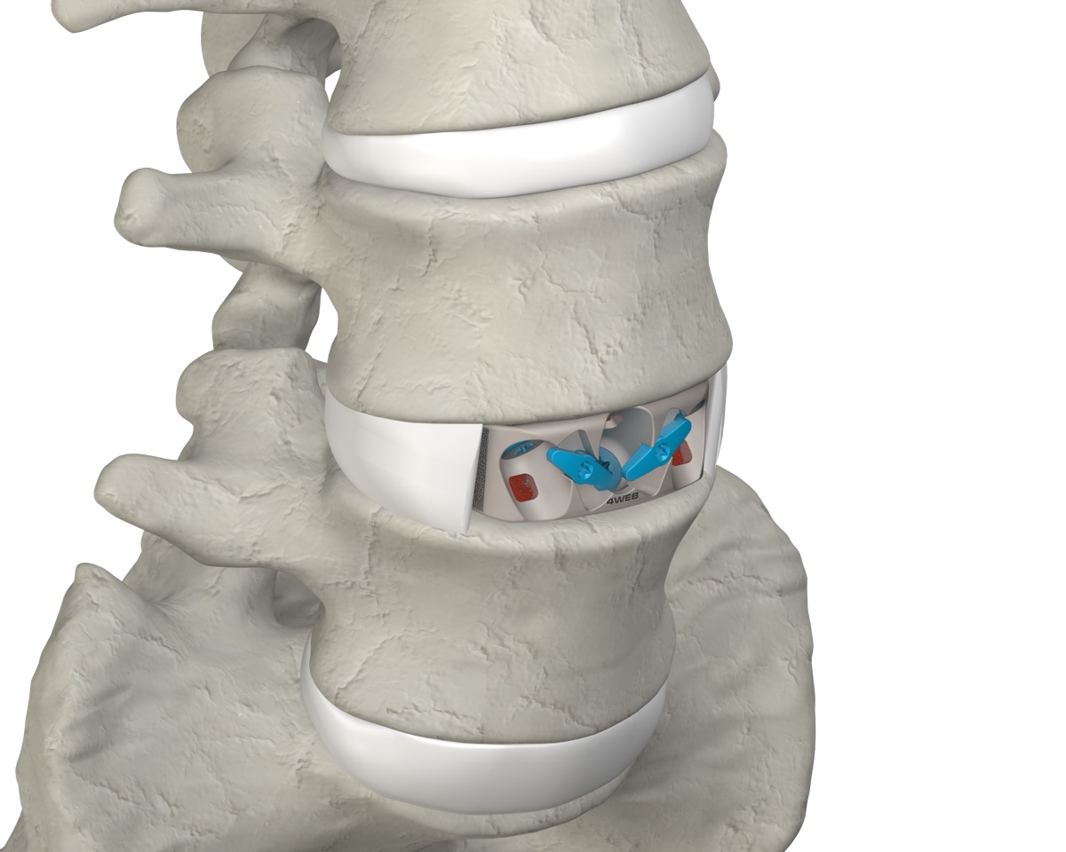 ASTS-SA final implant placed within the anterior spine