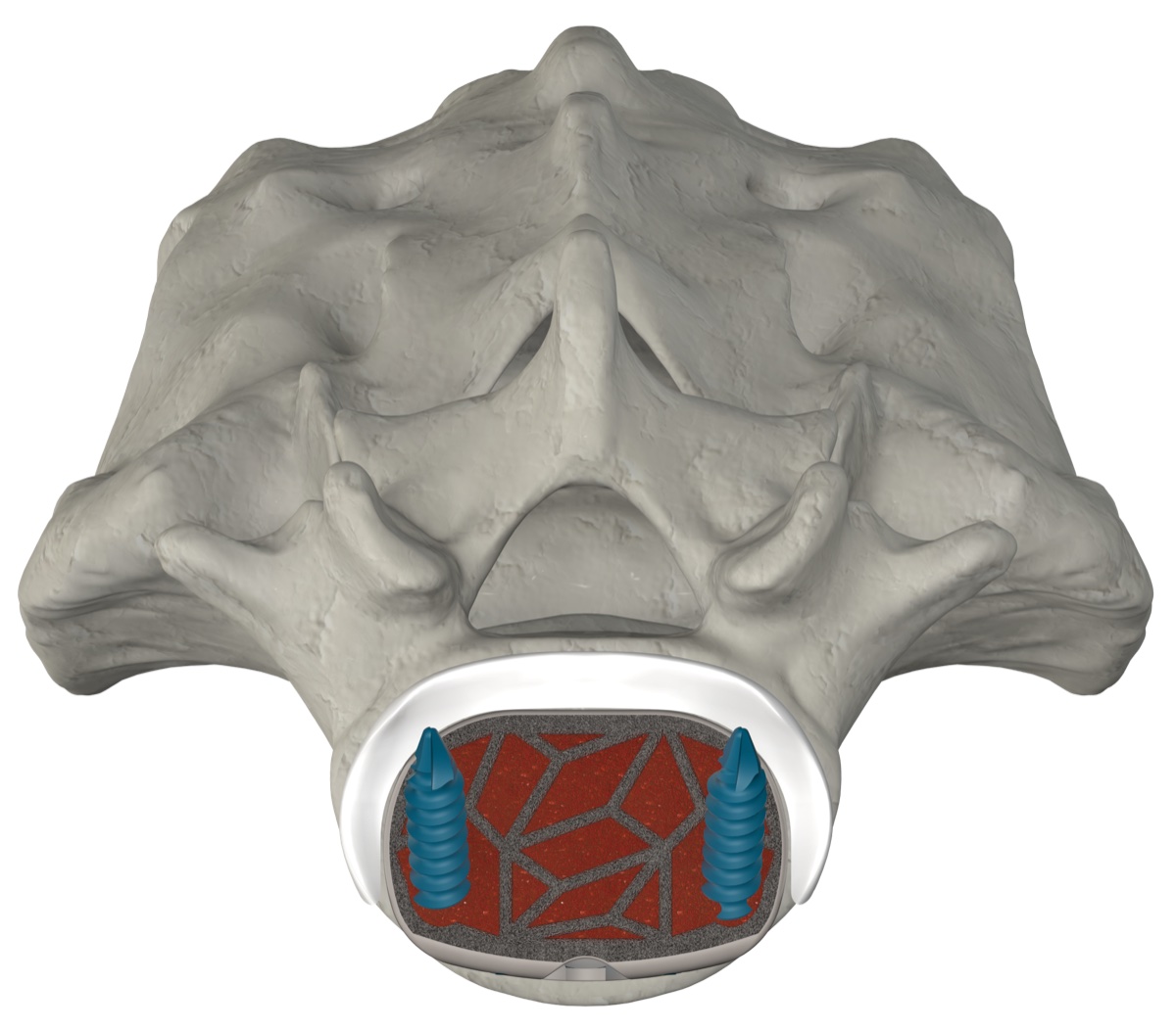 ASTS-SA cage cross-section within the vertebral body
