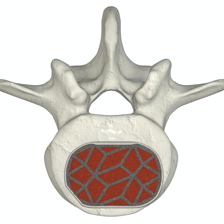 ASTS anterior view within the vertebral body