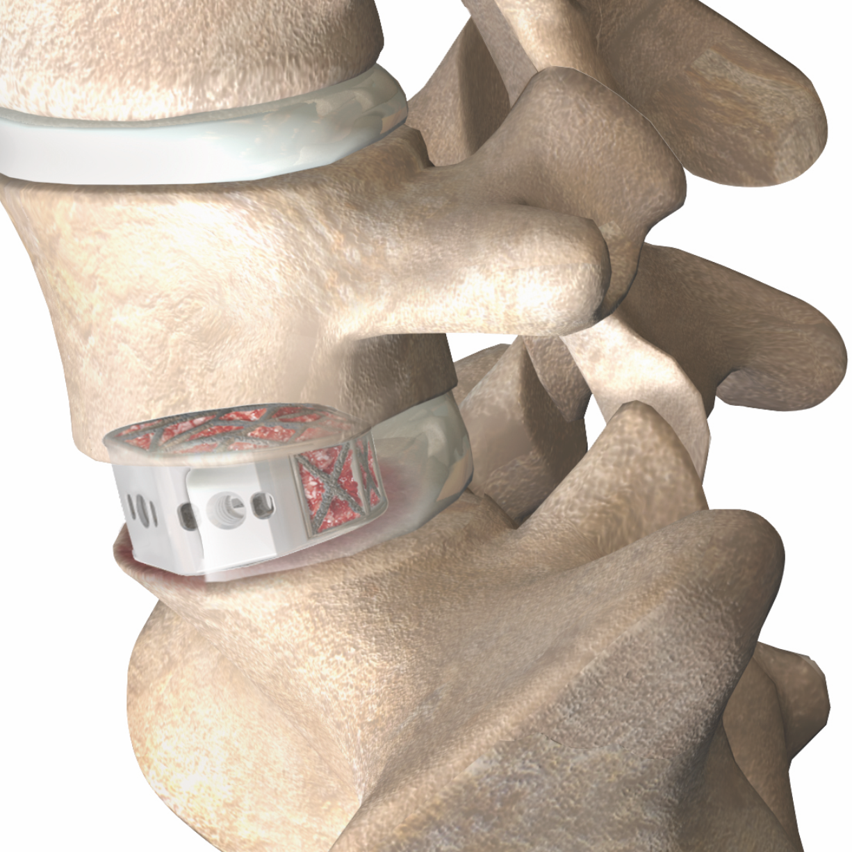 ASTS placed within the lumbar spine