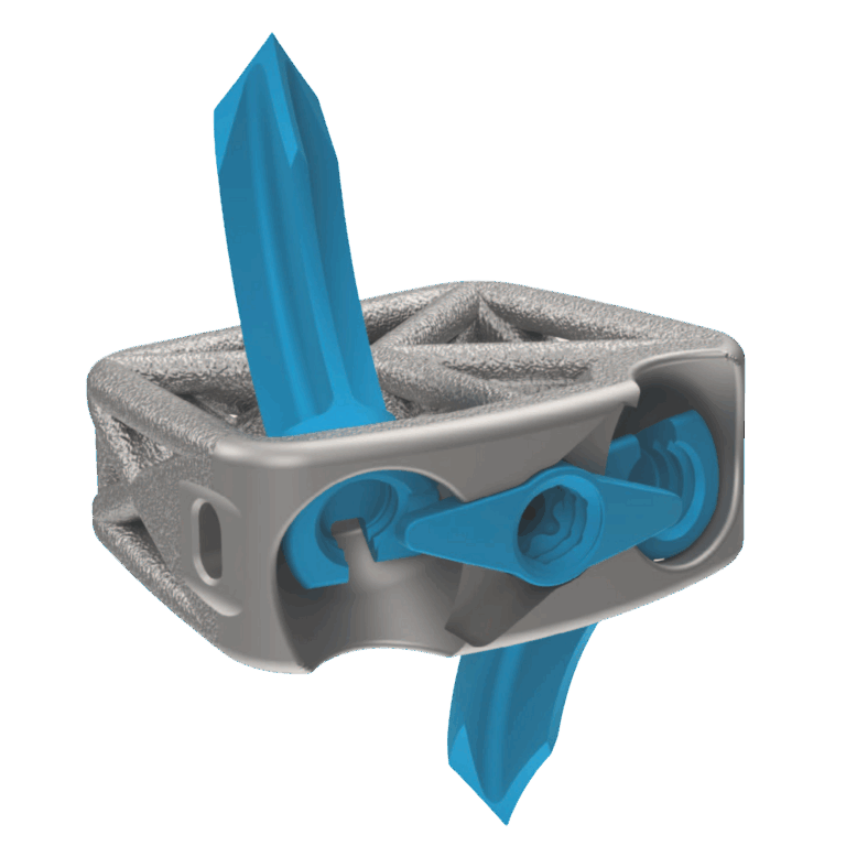 Cervical Spine Truss System™ – Anchor Fixation