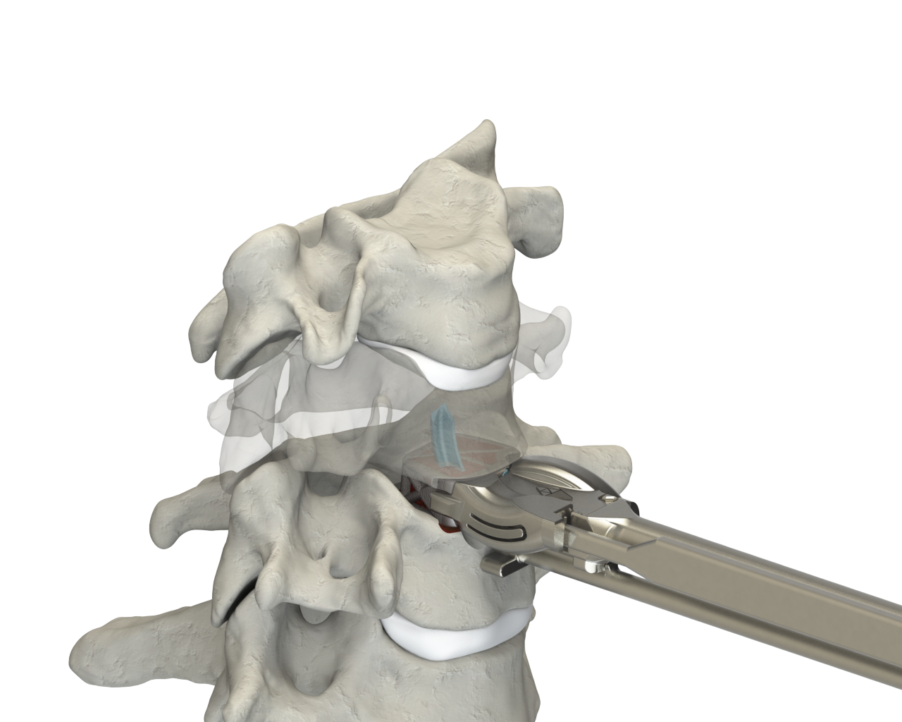 CSTS-SA with Anchor Fixation insertion into the disc space