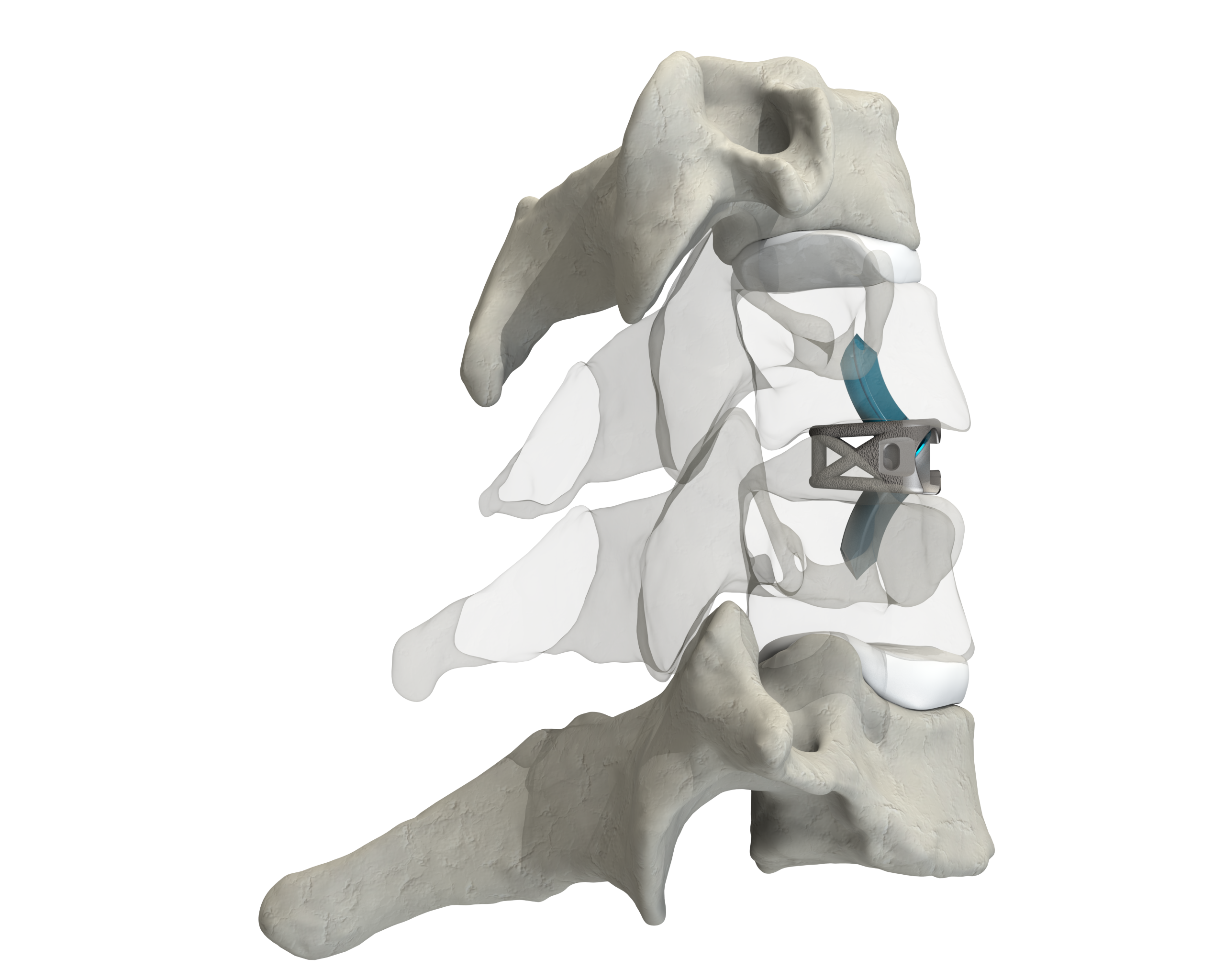 CSTS-SA with Anchor Fixation placed within the cervical spine