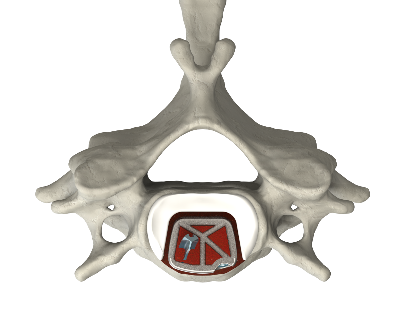 CSTS-SA with Anchor Fixation superior view within the vertebral body