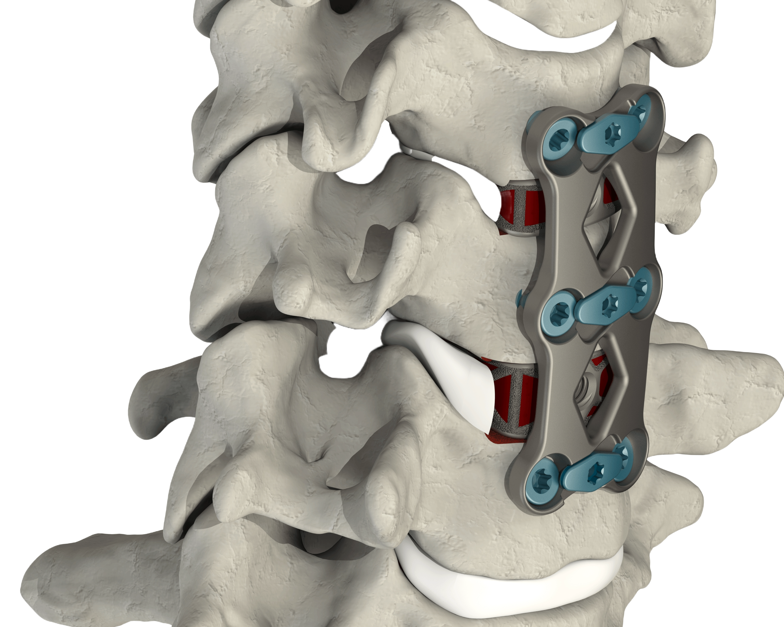 CSTS-PS placed within the cervical spine