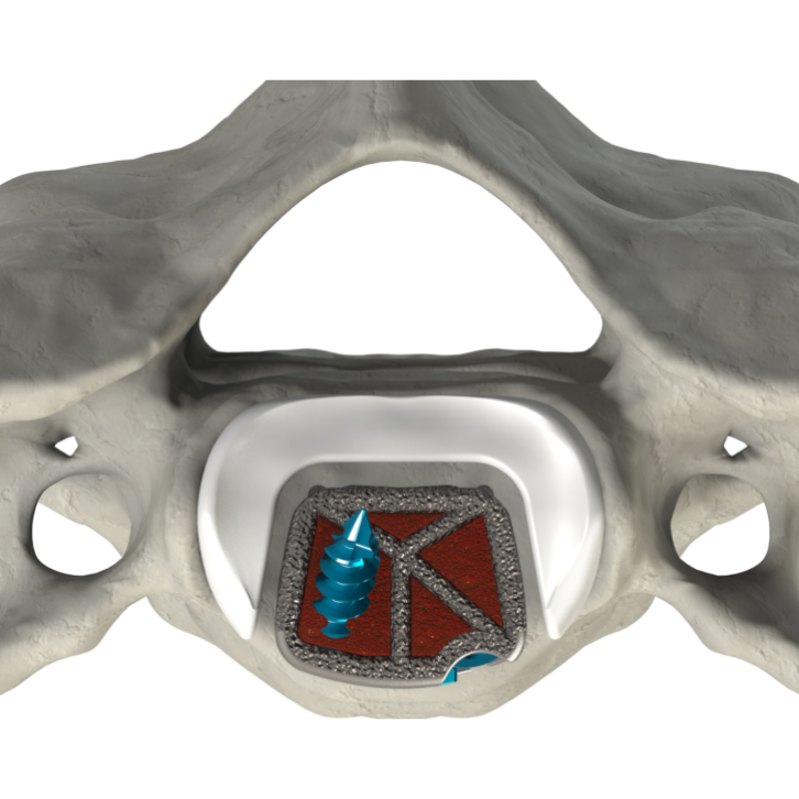 CSTS-SA posterior view within the vertebral body