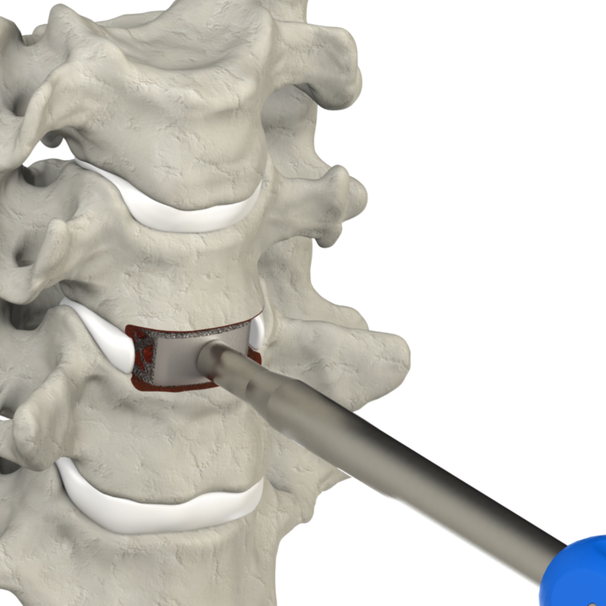 CSTS insertion into the disc space