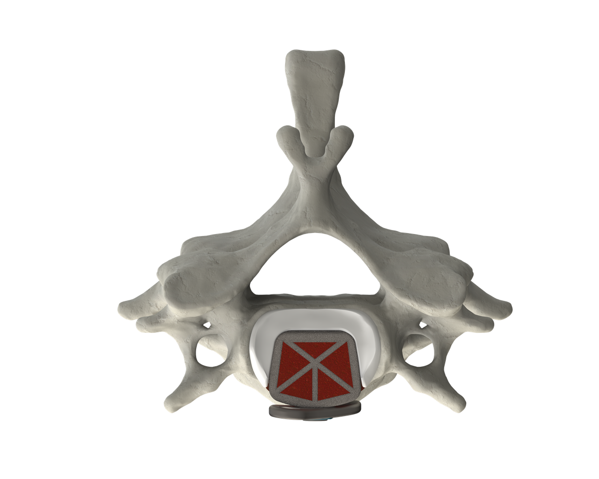 CSTS 2.0 anterior view within the vertebral body