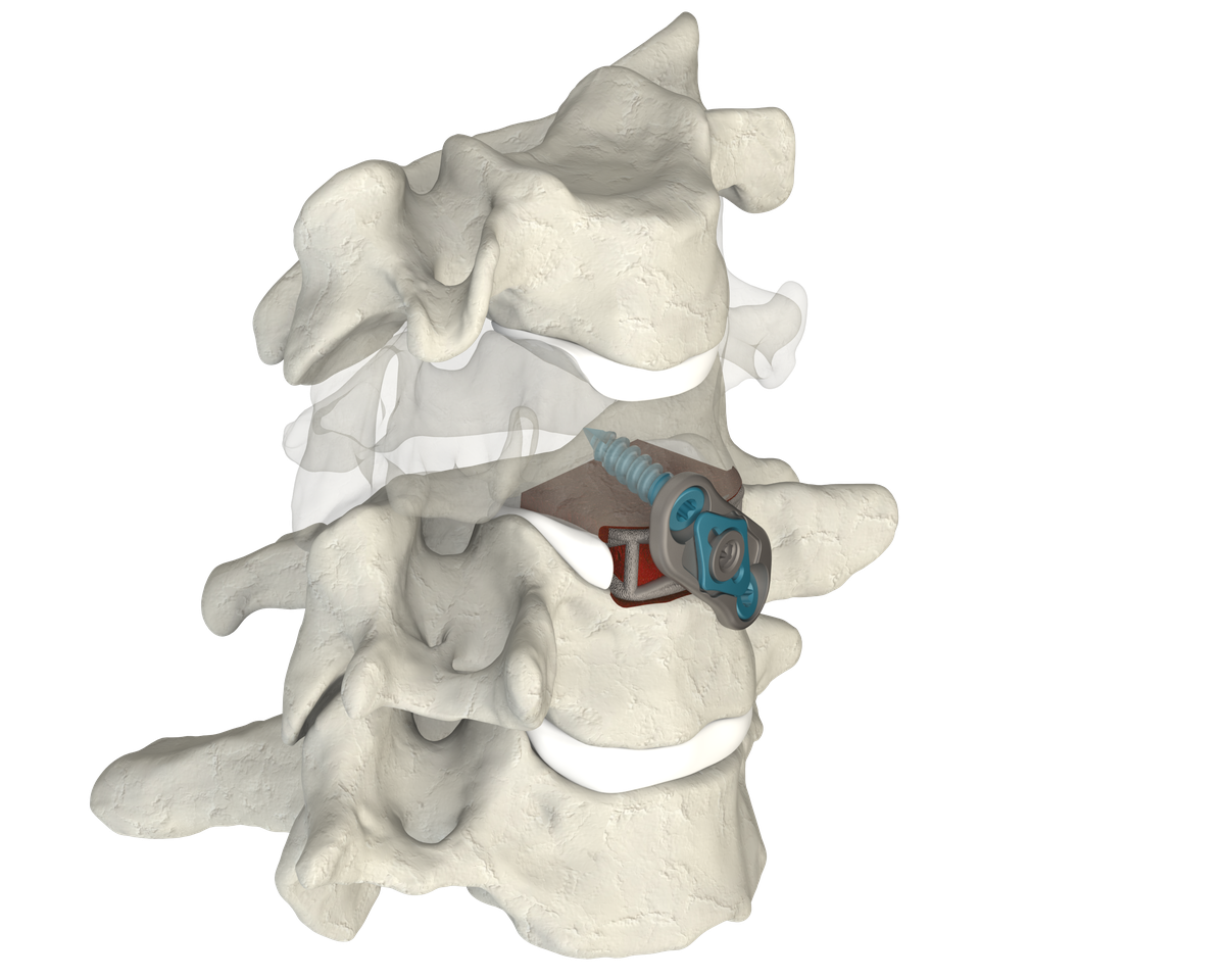 CSTS 2.0 placed with integrated plate and screw
