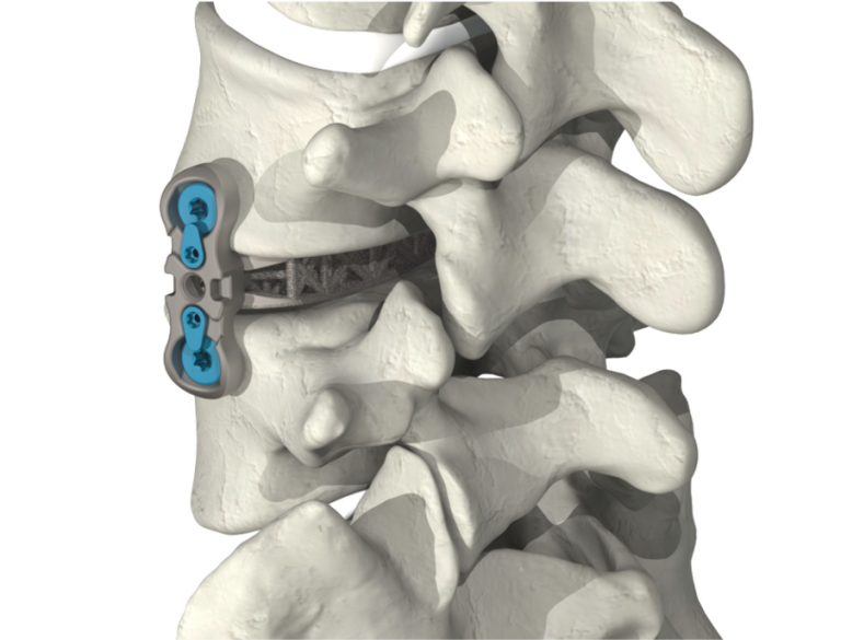 Lumbar Spine Plating Solution placed within the lumbar spine