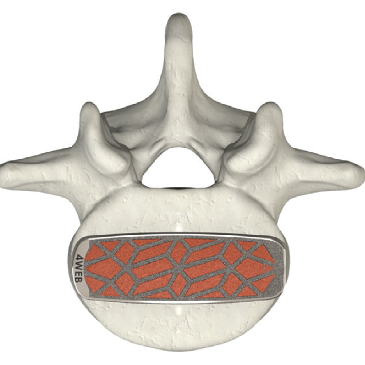 LSTS superior view within the vertebral body