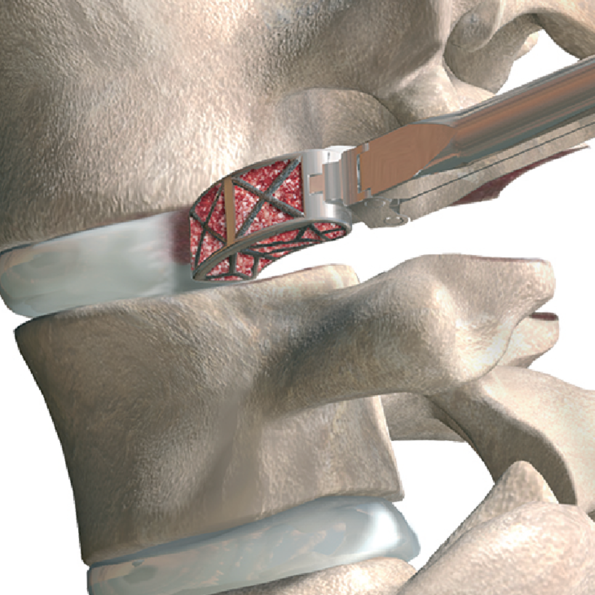 PSTS insertion into the disc space