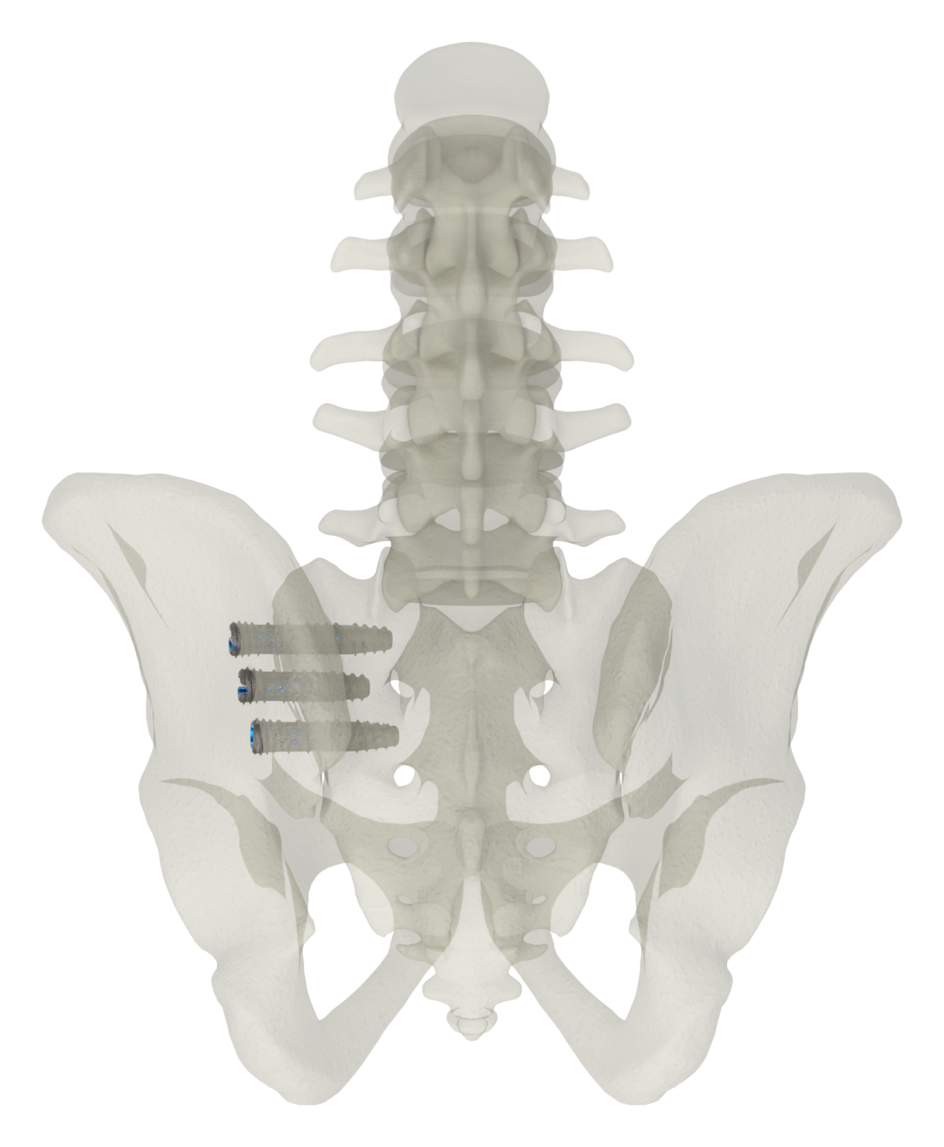 SJTS lateral approach, outlet view of screw placement