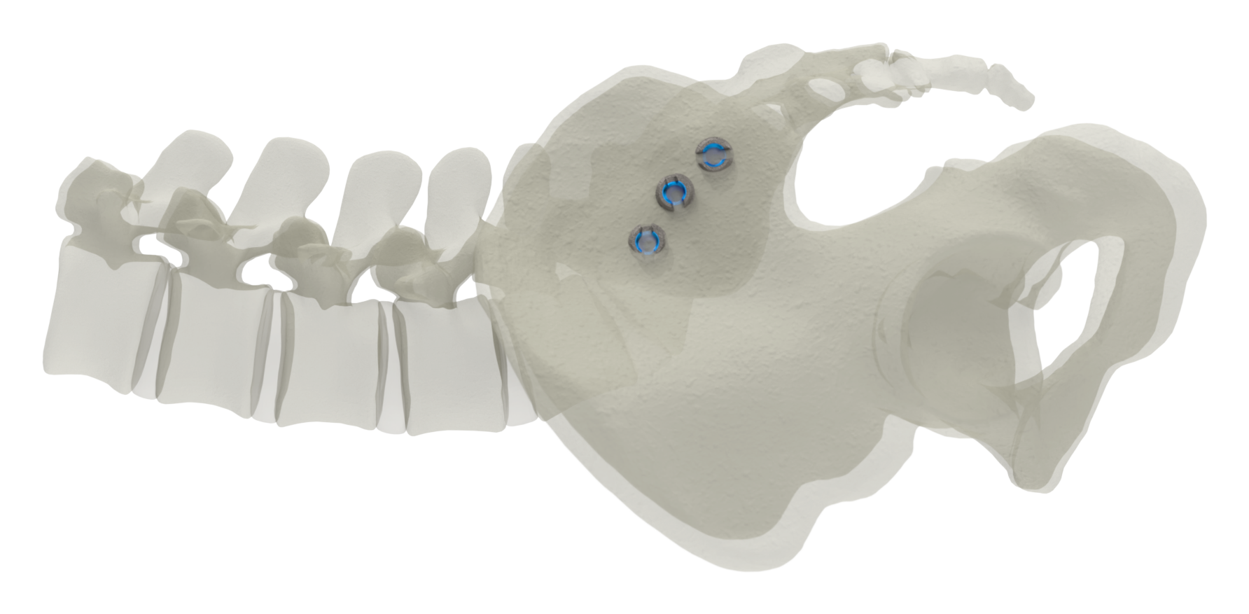SJTS lateral approach, lateral view of screw placement