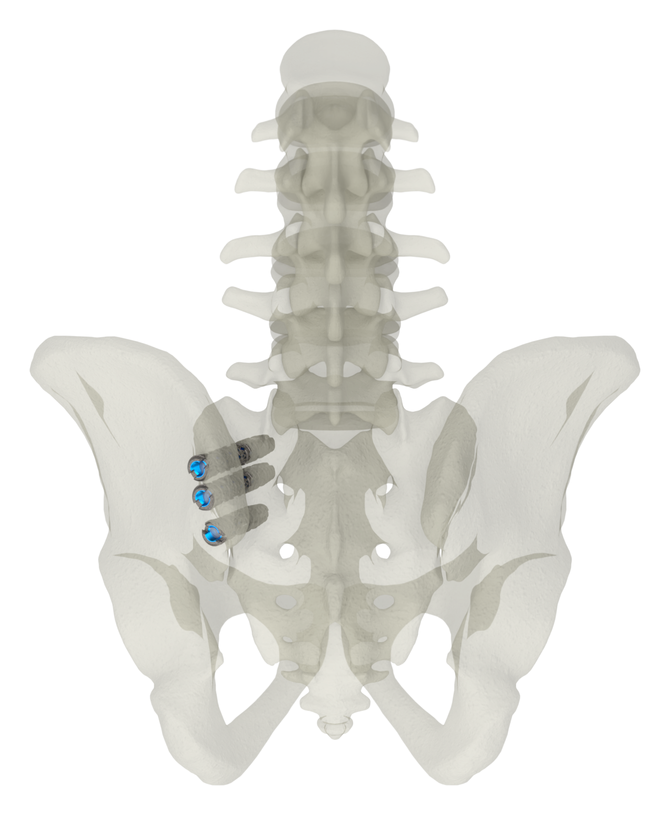 SJTS posterior approach, outlet view of screw placement