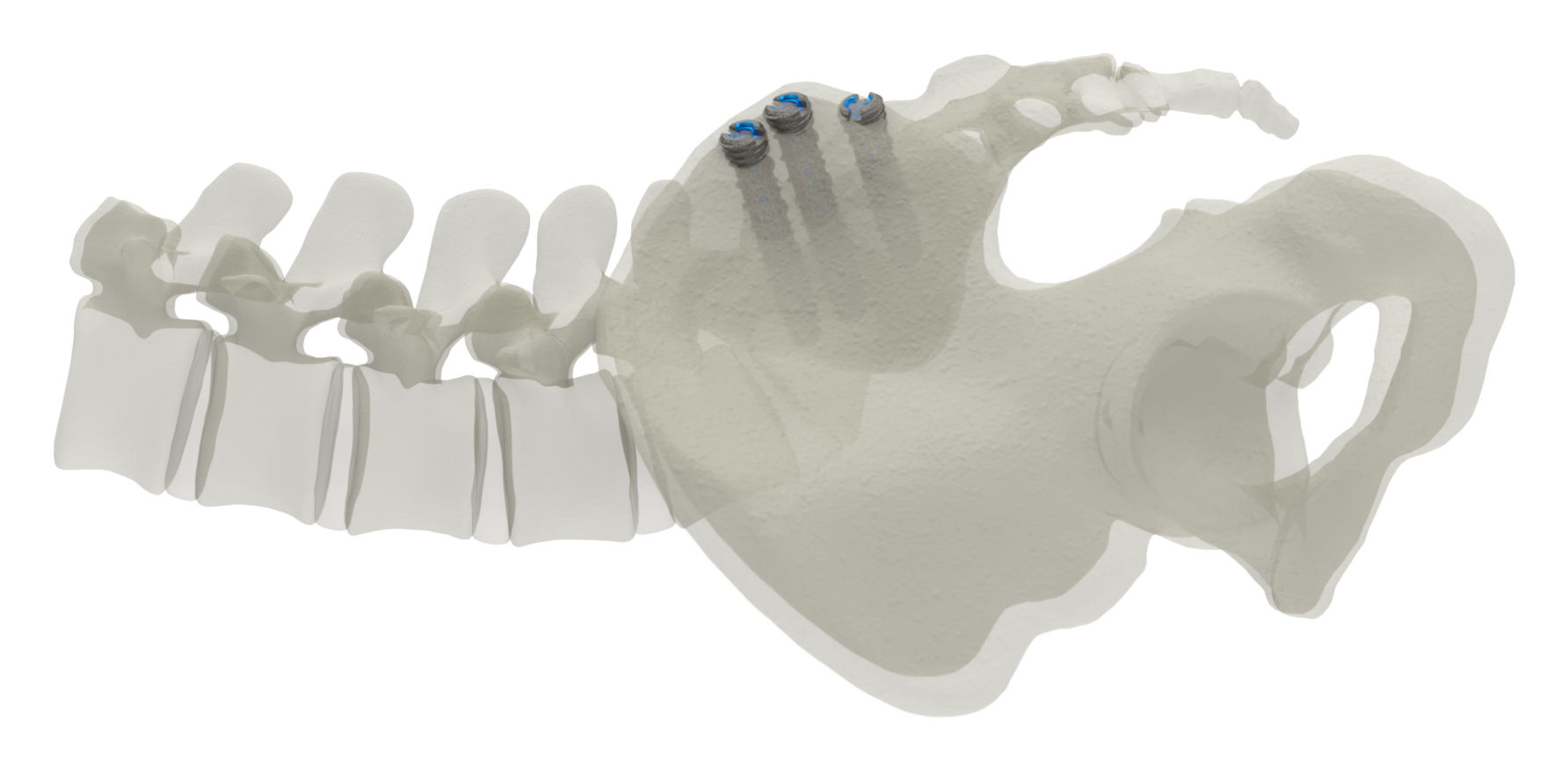 SJTS posterior approach, lateral view of screw placement